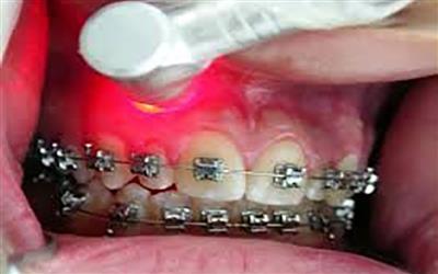 استفاده از لیزر در ارتودنسی دندان