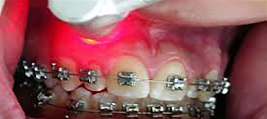 استفاده از لیزر در ارتودنسی دندان