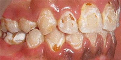 عوارض ارتودنسی دندان