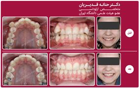 ارتودنسی ثابت همراه با کشیدن دندان