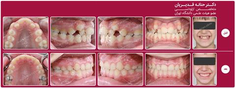 ارتودنسی ثابت بدون کشیدن دندان