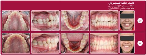 ارتودنسی ثابت با کشیدن دندان