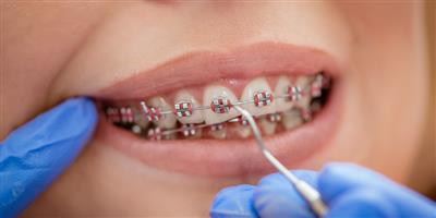 چگونه از دندان‌ها حین درمان ارتودنسی‌ مراقبت کنیم
