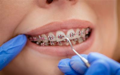 چگونه از دندان‌ها حین درمان ارتودنسی‌ مراقبت کنیم