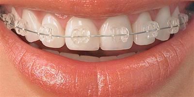 مراحل مختلف ارتودنسی دندان