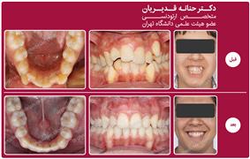 ارتودنسی ثابت همراه با کشیدن دندان