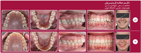 ارتودنسی ثابت بدون کشیدن دندان